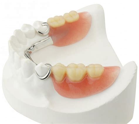 Partial Dentures – Aesthetech Denture Clinic