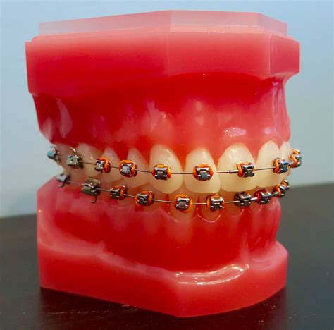 Self-Ligating Braces At Pearl Align: Everything You Should Know About