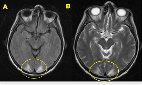 Brain MRI w/wo contrast. A) T2-TSE sequence, B) T2-FLAIR sequence ...