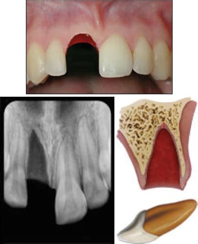 Tooth Avulsion - ALiEM