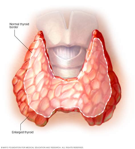 Graves' disease Disease Reference Guide - Drugs.com