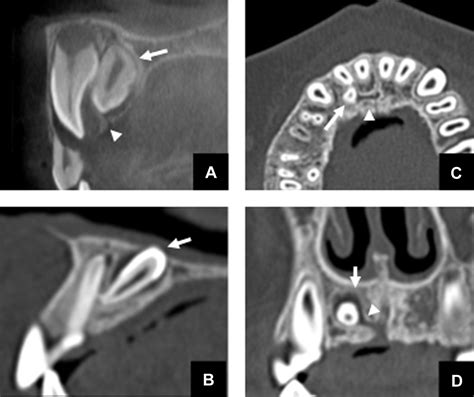 Characteristics of the gubernaculum tracts in mesiodens and maxillary anterior teeth with ...