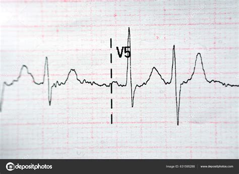 Ecg Electrocardiograph Paper Shows Normal Sinus Rhythm Nsr Frequent ...