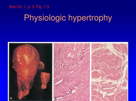 PPT - Splenic infarcts – gross Coagulative necrosis PowerPoint Presentation - ID:1321943