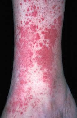 Hypersensitivity Vasculitis: Background, Pathophysiology, Etiology