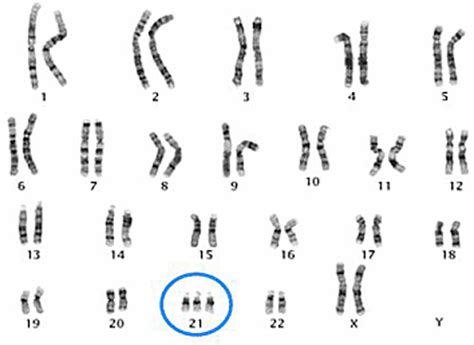 Karyotype - Down Syndrome