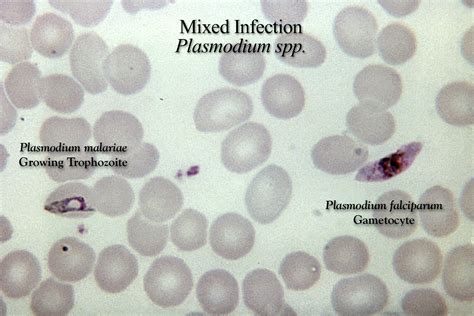 Free picture: thick, film, micrograph, mixed, falciparum, malariae, parasitic, infection