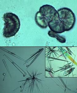 Crystals formed from sulfa drugs | eClinpath