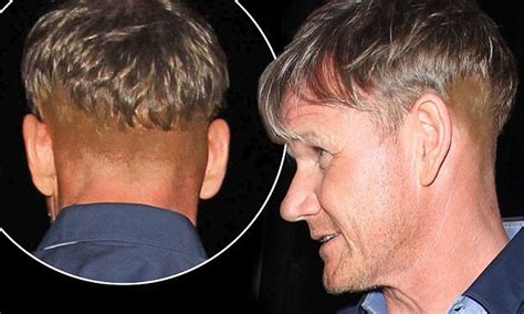 Gordon Ramsay Before And After Hair Transplant