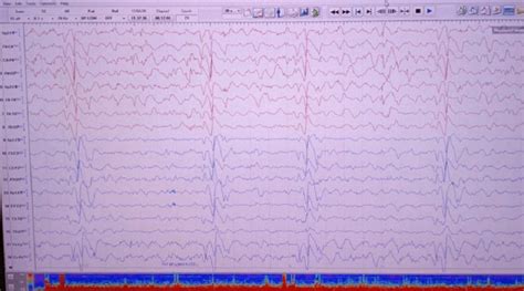 Electroencephalography (EEG) of a SSPE patient depicts the periodic... | Download Scientific Diagram