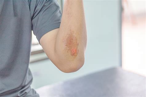 Abrasion Wound Stock Photo - Download Image Now - iStock