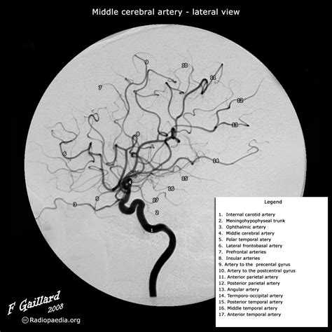 Log In | Radiopaedia.org | Radiology, Interventional radiology, Arteries