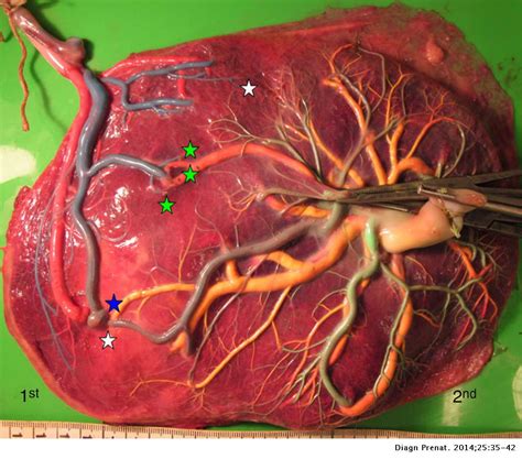 Monochorionic twin placentas: Injection technique and analysis | Diagnóstico Prenatal