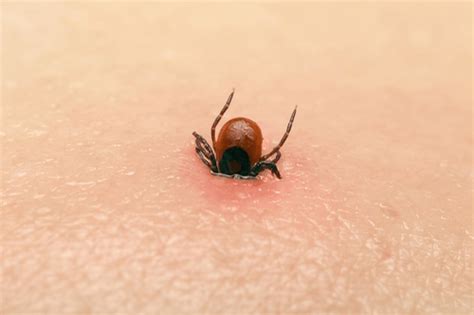 Chiggers: Facts, symptoms, infestation, diagnosis, and remedies | FactDr