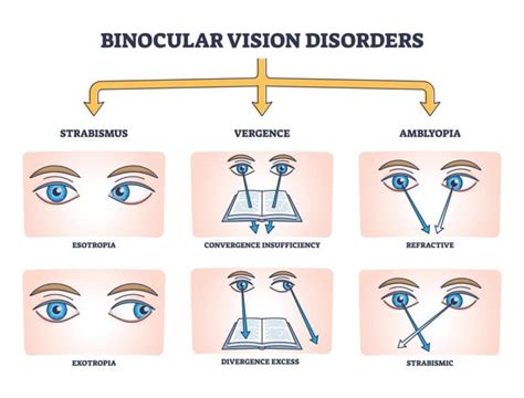 Convergence Insufficiency: Causes, Symptoms and Treatments