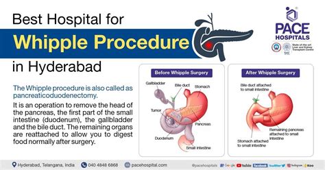 Whipple Procedure Incision