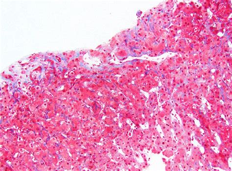 Pathology Outlines - Cardiac (congestive) hepatopathy and Fontan associated liver disease