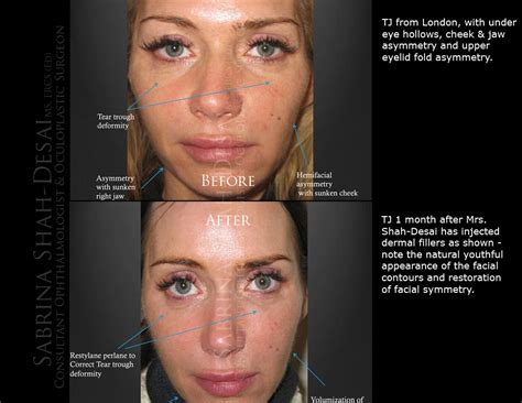 Case Study : Dermal Filler (Liquid Face Lift) | Aesthetic Treatments in UK.