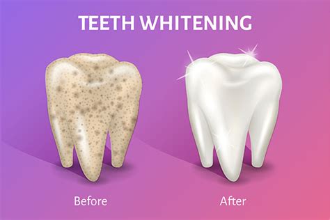 Side Effects of Teeth Whitening Treatments