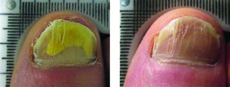 Laser Therapy For Toenail Fungus Specialist - Clifton, NJ: Premier Podiatry: Velimir Petkov, DPM ...