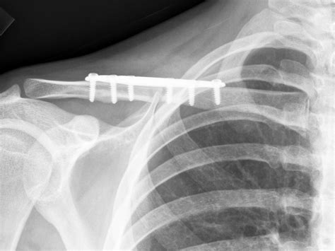 Clavicle Plating System | Acumed