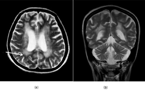 Axial (a) and coronal (b) T2-weighted MRI images show bilateral ...