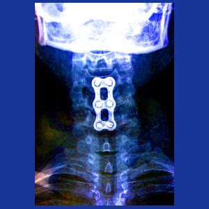 Cervical Spinal Fusion - Neck Pain