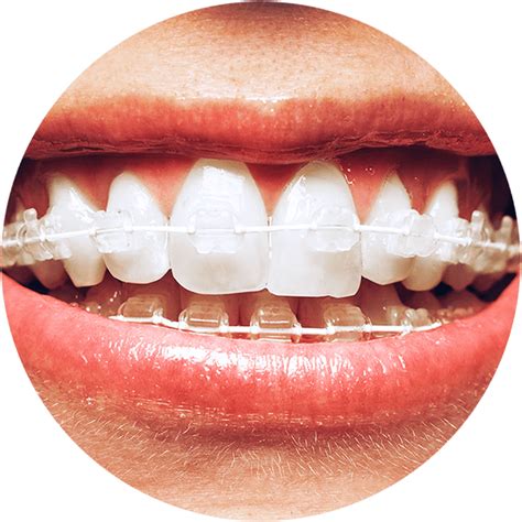 Six Month Smiles - Guided Orthodontics for the General Dentist