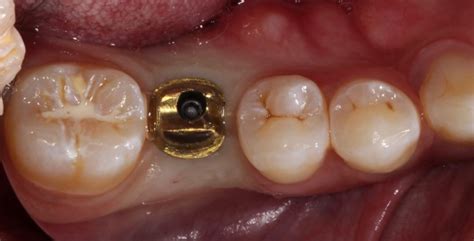 Implant Crowns: Screw-Retained or Cement-Retained Restorations? - Spear Education