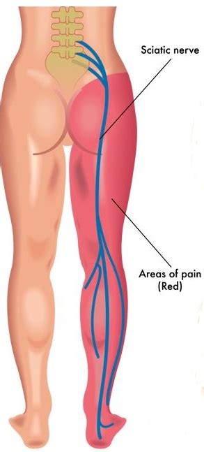 Bulging Disc L4-L5 – 2023 Guide to Symptoms & Treatment