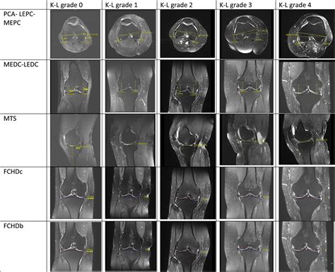 Kellgren–Lawrence grade of osteoarthritis is associated with change in ...