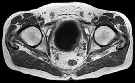 Bladder carcinoma MRI | Urology News