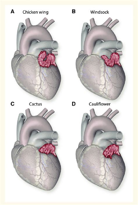 A Different Anatomical Morphologies Of The Left Atrial Appendage B ...