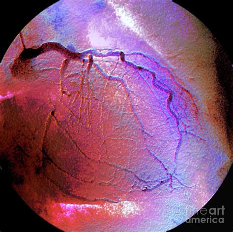 Coronary Artery Stenosis #1 by Zephyr/science Photo Library