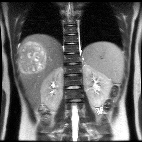 Radiology Cases: Pyogenic Liver Abscess