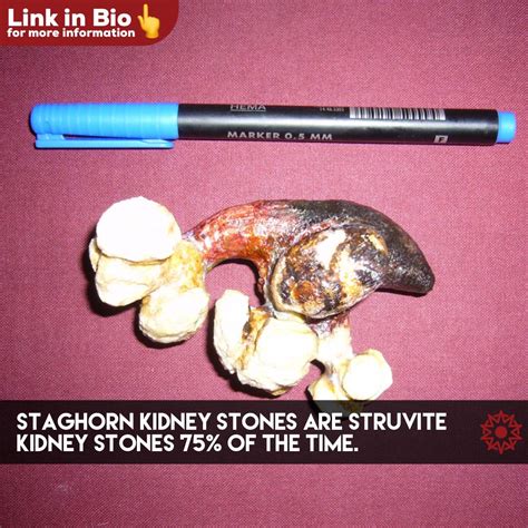 Struvite Kidney Stones: The Bacteria-Based Stone | Kidney stones ...