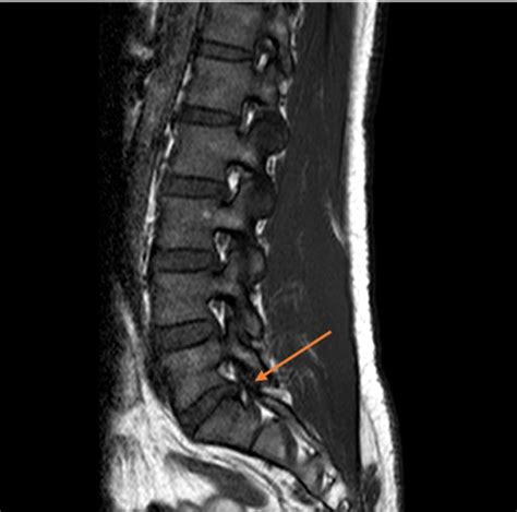 MRI of the lumbar spine showed degenerative retrolisthesis of L5 on S1 ...