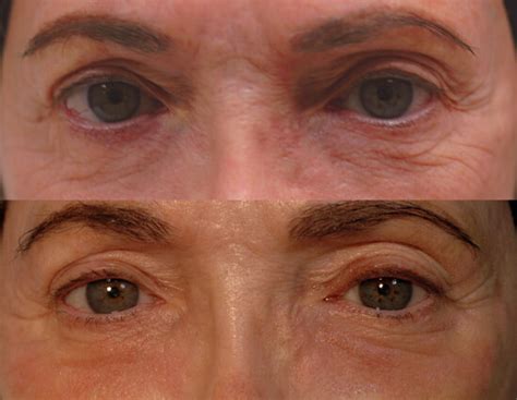 Fractional Laser Resurfacing For Eye Wrinkles