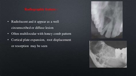 Odontogenic Myxoma