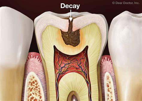 Tooth Decay Prevention | Kelvin B. Smith, D.D.S., LLC | Baltimore Maryland