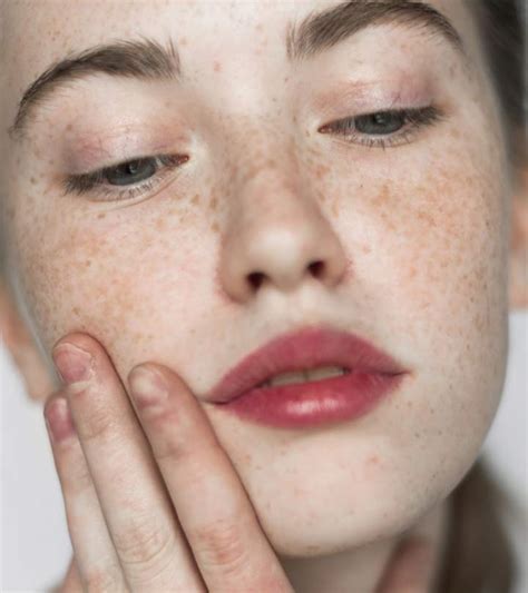 Hyperpigmentation: Causes, Symptoms, Types, And Treatments