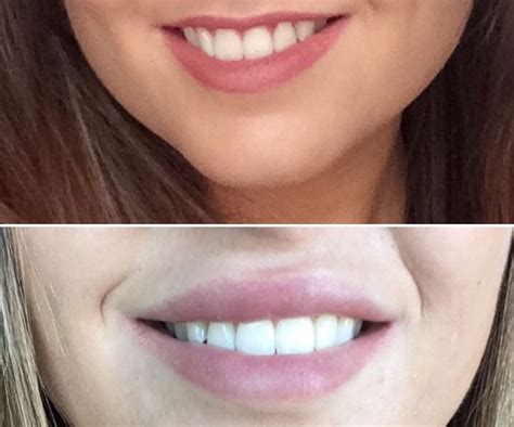 Before and After lip fillers / lip injections. Read all about my experience: http ...
