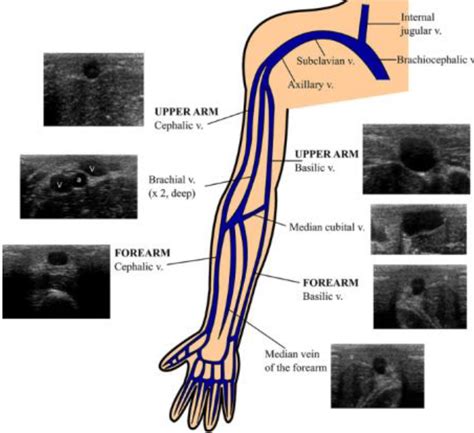 Ultrasound Guided Vascular Access • LITFL • Ultrasound Library