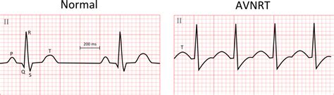 Av Nodal Reentrant Tachycardia