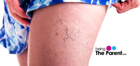 Varicose Veins During Pregnancy - Being The Parent