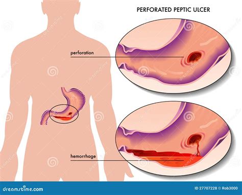 Esophagus Ulcer Affected. Ulcer Of Esophagus Vector Illustration ...