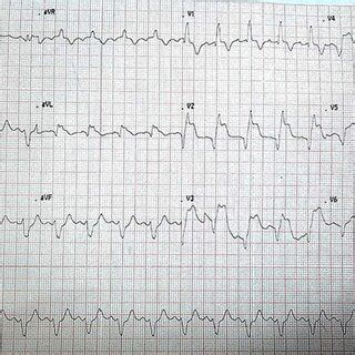 ECG suggesting acute MI of the anterior wall MI, myocardial infarction ...