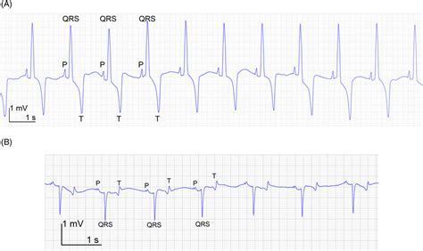 (A) A modified base‐apex ECG of donkey 1 shows association between P... | Download Scientific ...