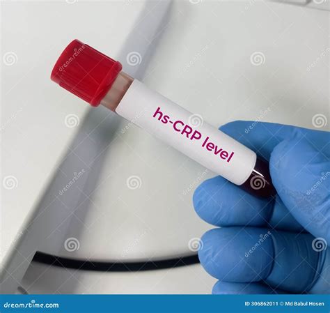 Blood Sample for Hs-CRP (high Sensitivity - CRP) Test, for the ...