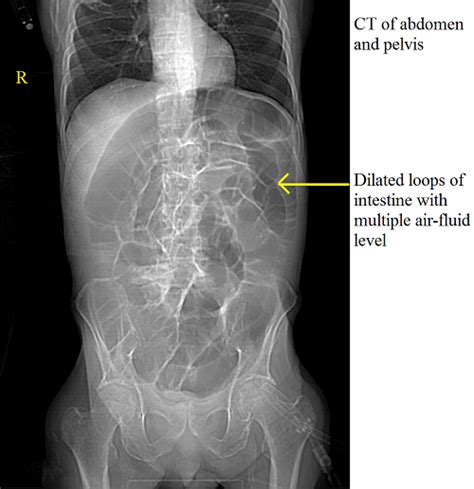 Ileus CT - wikidoc